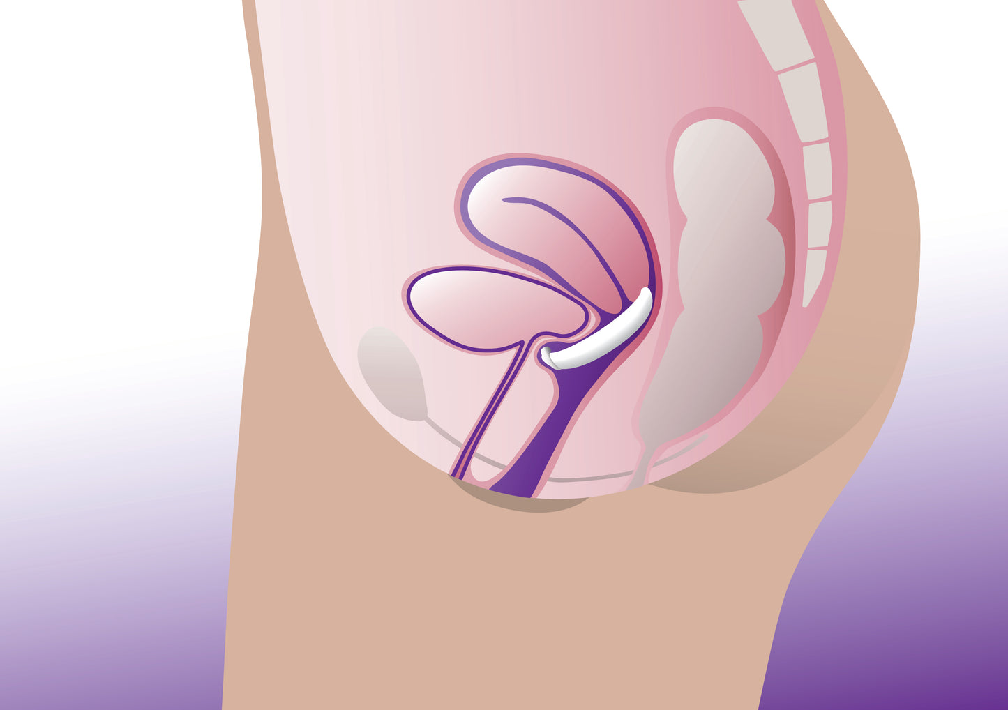Pessaire Dish Urétral ProFem
