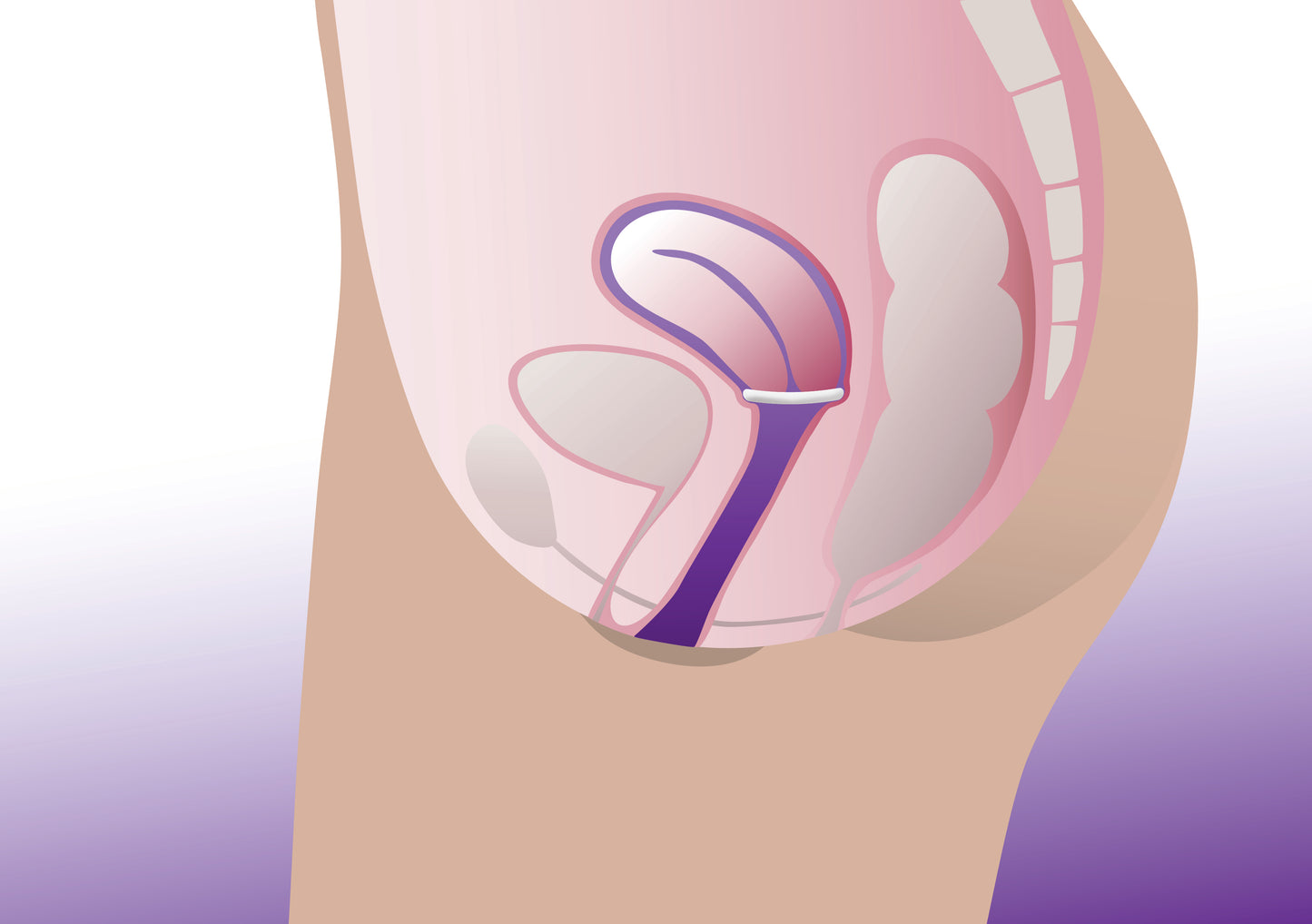 Pessaire Anneau ProFem, avec support