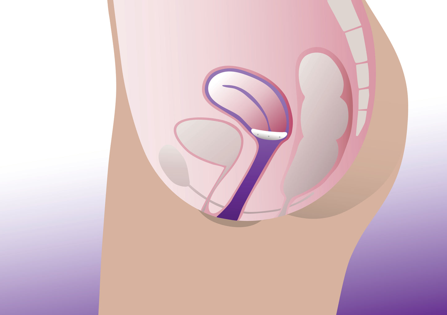 Pessaire Tamis / Shaatz ProFem