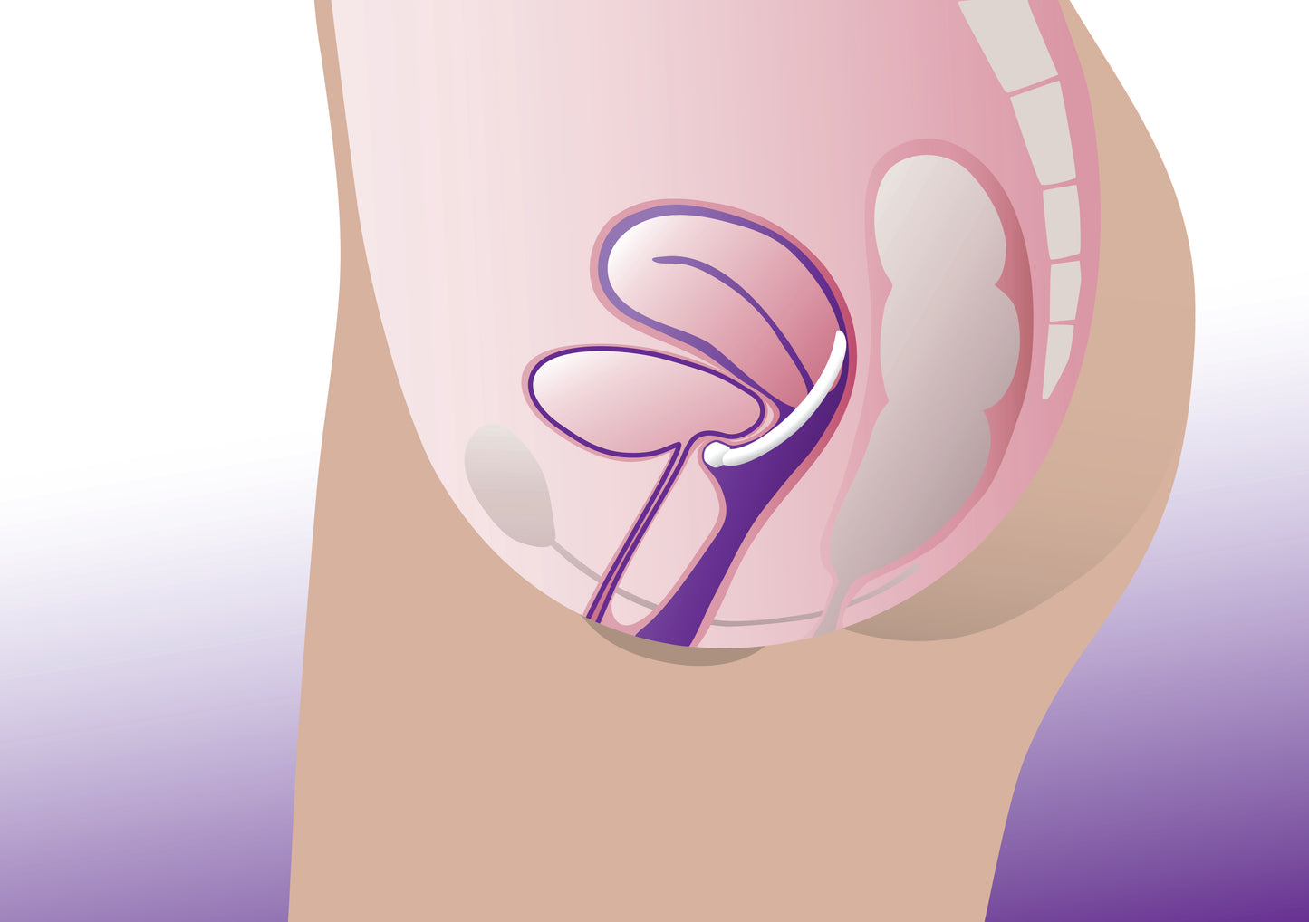 ProFem Urethra Pessar